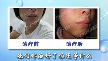 白癜风最新治疗方法,白癜风最新治疗方法，曙光初现的希望之光，白癜风最新治疗方法，曙光初现的希望之光攻克白斑难题